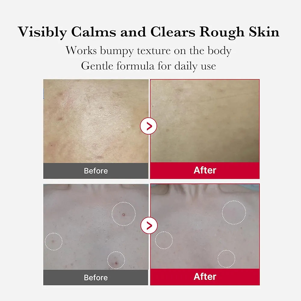 MEDICUBE - Red Acne Body Wash Off Peeling Shot - 110g
