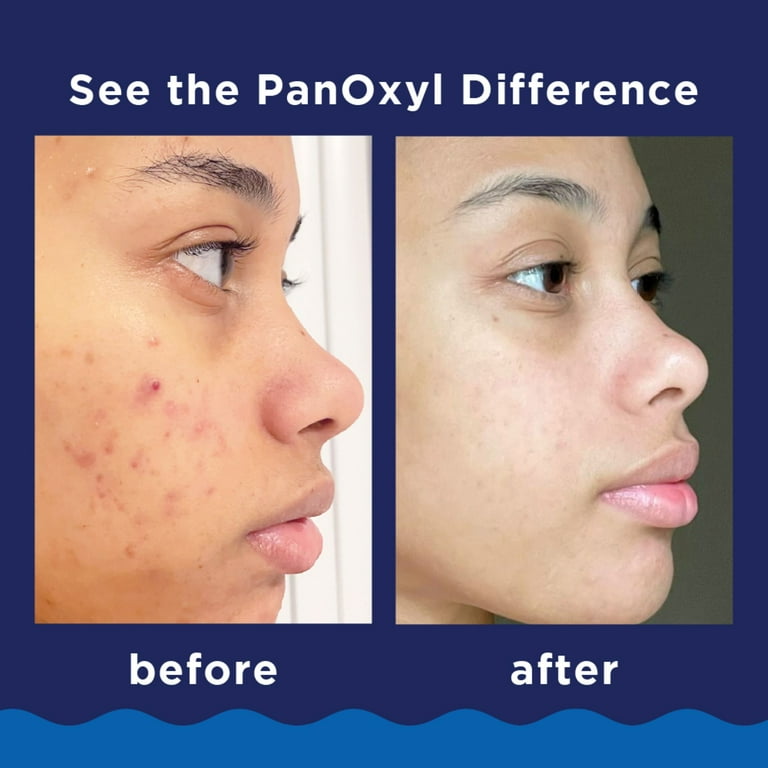PANOXYL - Acne Foaming Wash Benzoyl Peroxide 4% Daily Control 170g